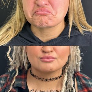 botox for chin dimples