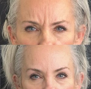 Before and after images showing treatment for fine lines and wrinkles using botox