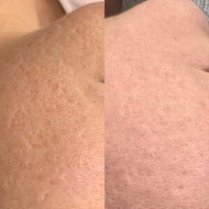 Before and after photos showing the improvement in ice pick and boxcar scarring with RF Microneedling and CO2 Laser treatments.