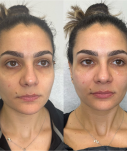 Before and after image of PRP treatment for undereye bags and dark circles, showing a noticeable reduction in puffiness and brighter under-eye area