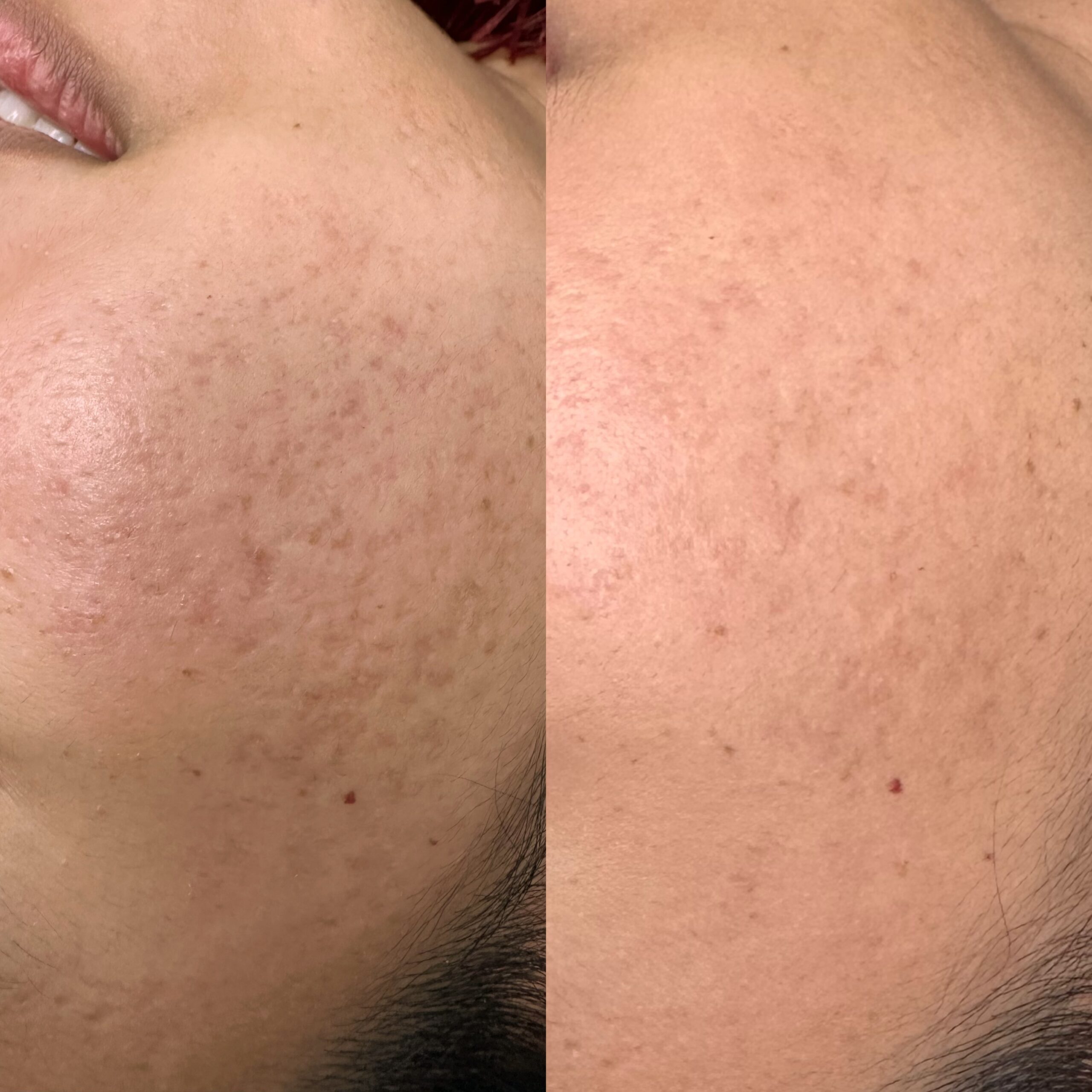 RF Microneedling on Acne Scars