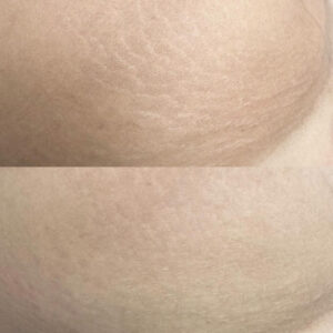 Before and after RF Microneedling treatment for stretchmarks, showing improved skin texture and reduced visibility of stretchmarks