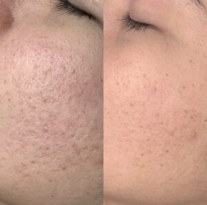 Before and after image showing reduced acne scars following RF Microneedling treatment, revealing smoother and clearer skin.