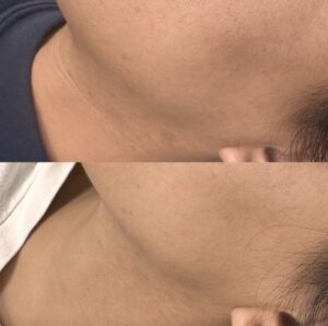 Before and after RF Microneedling treatment for neck bands. The image shows significant improvement in skin smoothness and reduced appearance of neck bands after the procedure