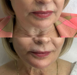 Before and after photo showing the effective treatment of smile lines with Botox and dermal fillers.