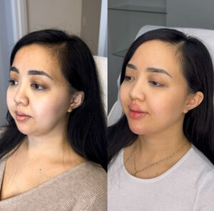 before & after of dermal fillers in the chin