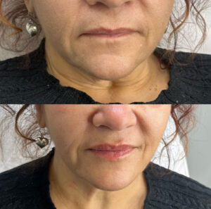 before & after on dermal fillers and botox for mature skin and volume loss