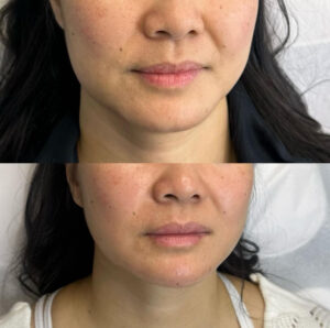 facial slimming with dermal filler and botox