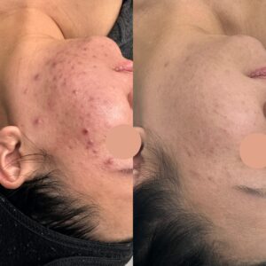 Before and after image showing the treatment of acne-prone skin with Laser Genesis