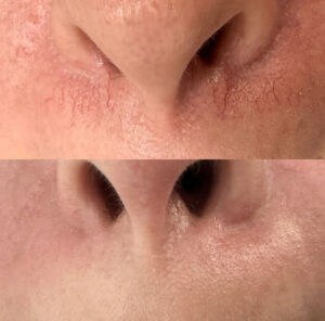 Before and After Cutera XEO 1064YAG Treatment for Broken Capillaries – Visible Reduction in Redness and Improved Skin Clarity