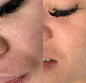 Before and after images of enlarged pore treatment using CO2 Laser, showcasing significant reduction in pore size and improved skin texture.