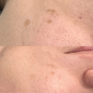 Before and after image showing effective reduction of skin discoloration and hyperpigmentation with IPL treatment.