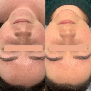 Before and after photos of rosacea treatment using IPL, demonstrating reduced redness and improved skin tone.