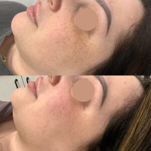 Before and After IPL Treatment for Sun Damage in Markham – Visible Reduction of Age Spots